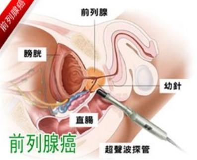 前列腺癌的早期癥狀是什么？