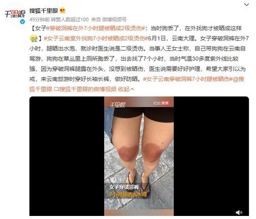 云南女子穿破洞褲7小時腿被曬傷，溫度30多度紫外線強烈